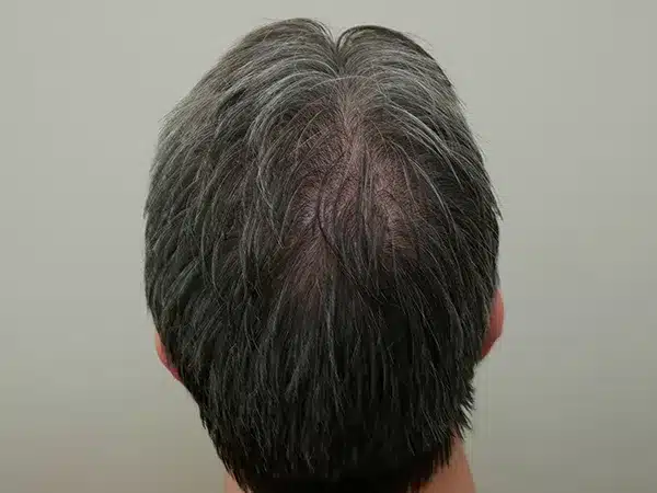 Hair Restoration