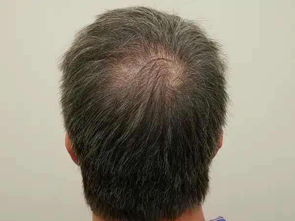 Hair Restoration
