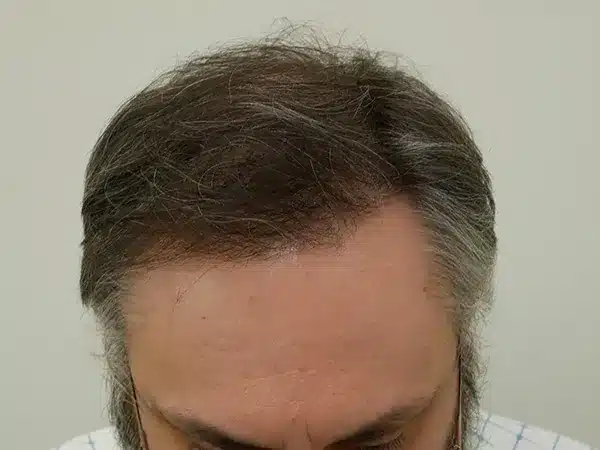 Hair Restoration