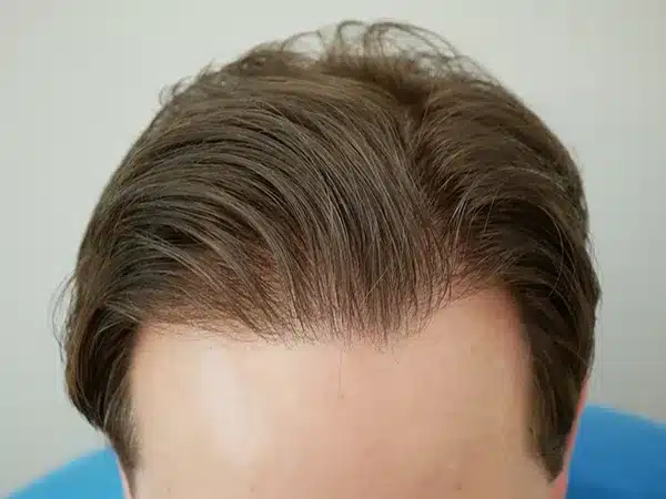 Hair Restoration