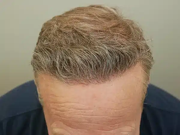 Hair Restoration