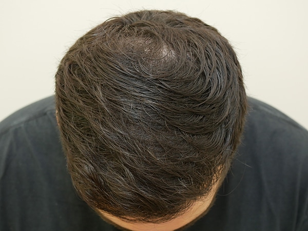 Hair Restoration