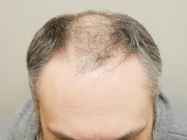 Hair Restoration