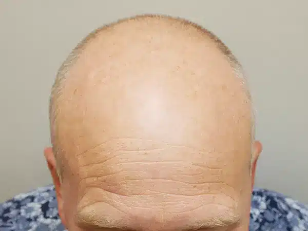 Hair Restoration