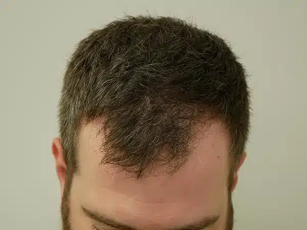 Hair Restoration