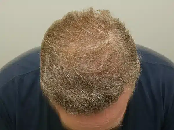 Hair Restoration