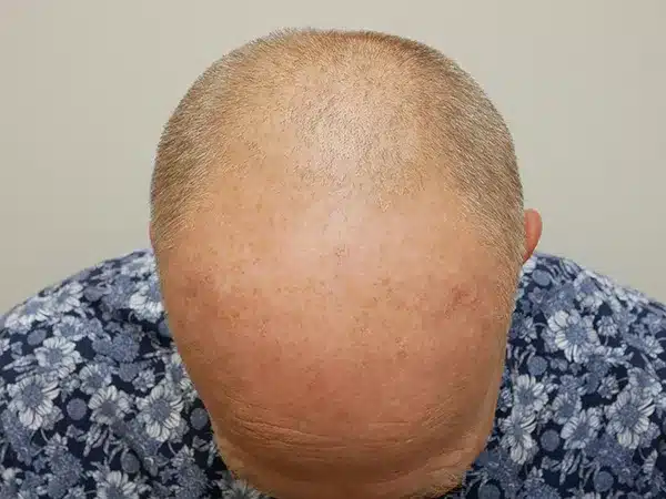Hair Restoration