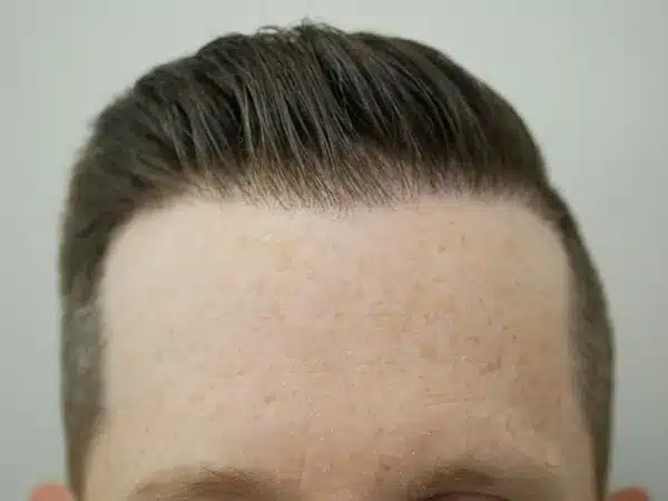 Hair Restoration