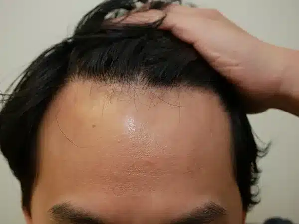 Hair Restoration