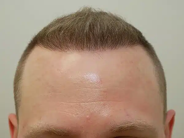 Hair Restoration