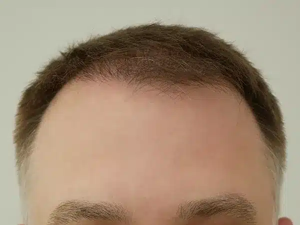 Hair Restoration