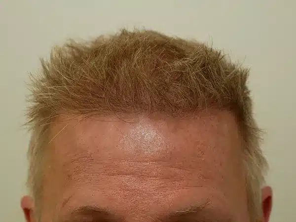 Hair Restoration