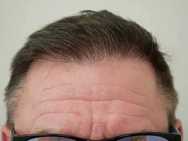 Hair Restoration