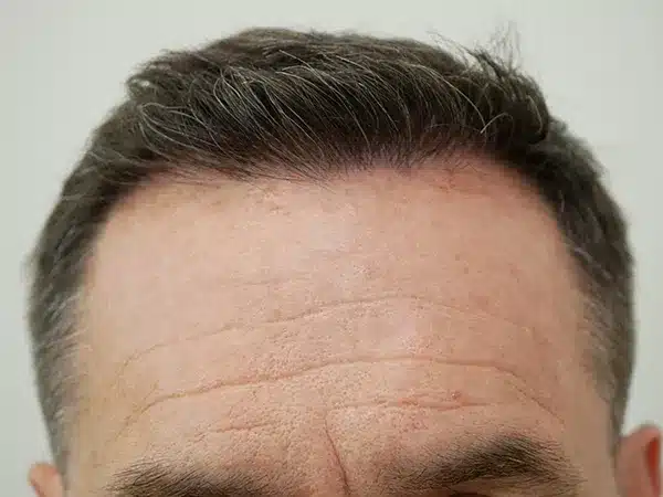 Hair Restoration