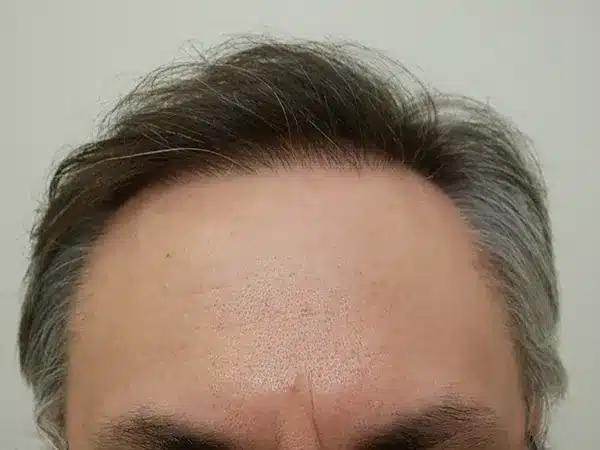 Hair Restoration