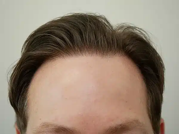 Hair Restoration