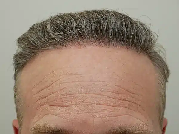 Hair Restoration