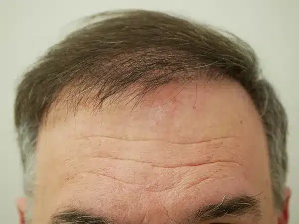 Hair Restoration