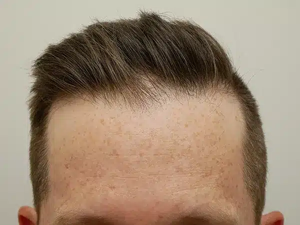 Hair Restoration