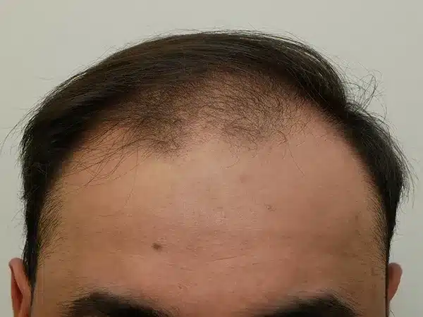 Hair Restoration