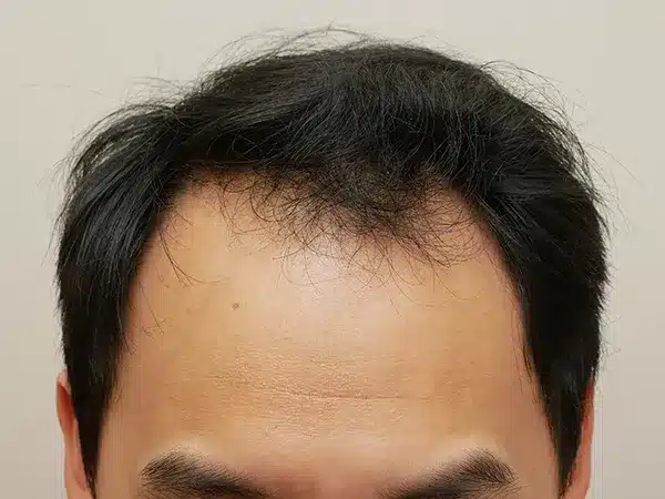 Hair Restoration