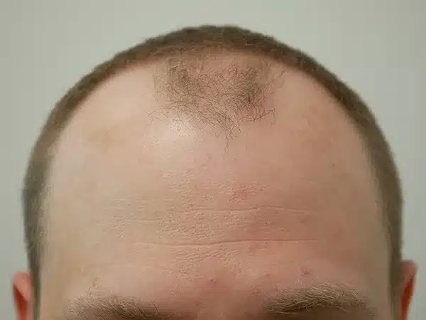 Hair Restoration
