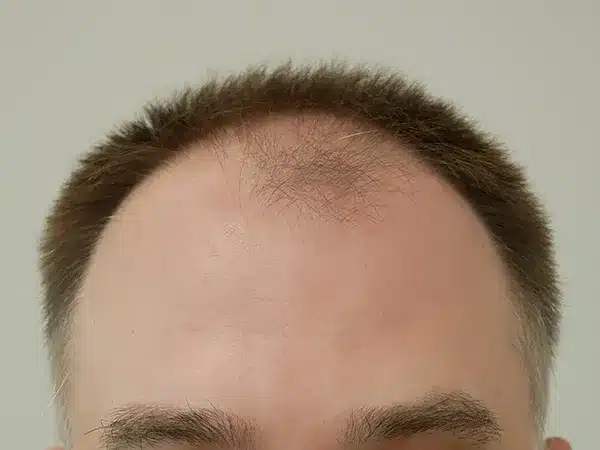 Hair Restoration