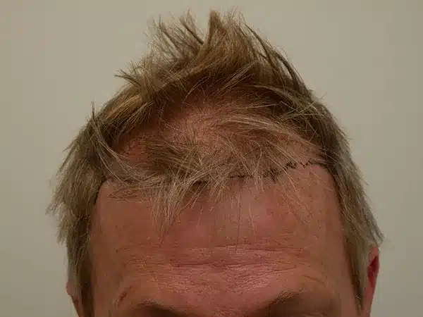Hair Restoration