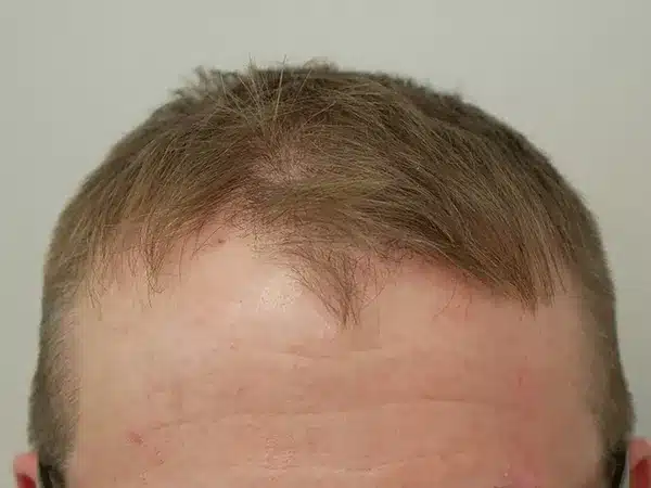 Hair Restoration