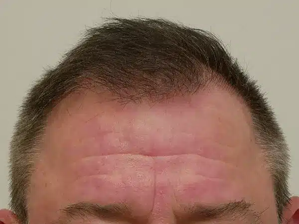 Hair Restoration
