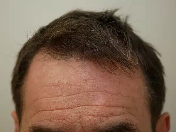 Hair Restoration