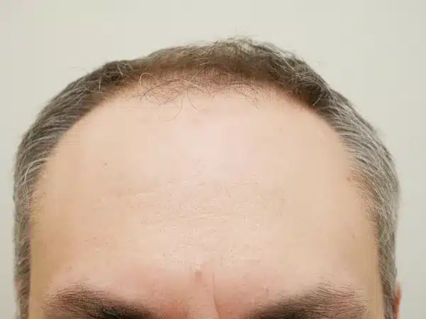 Hair Restoration