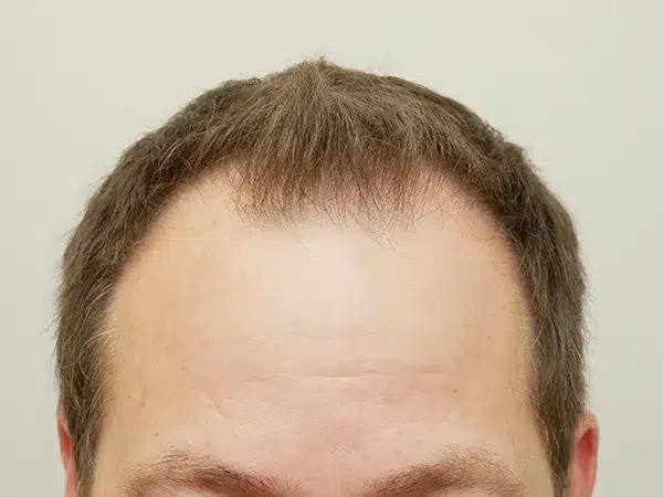 Hair Restoration