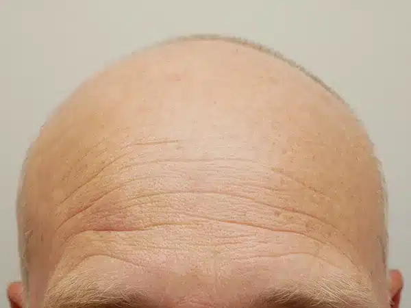 Hair Restoration