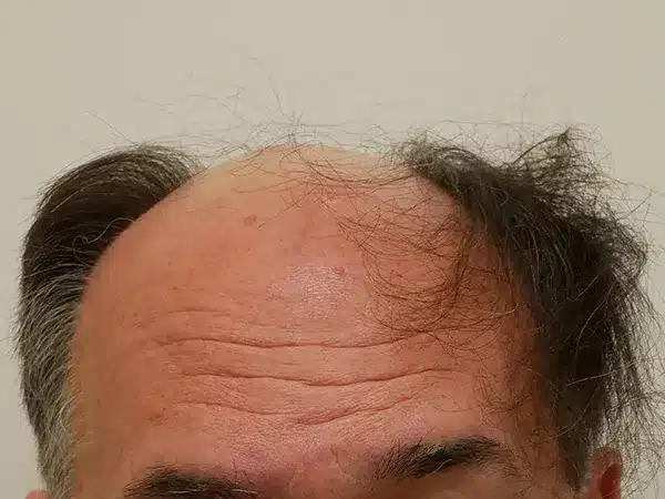 Hair Restoration