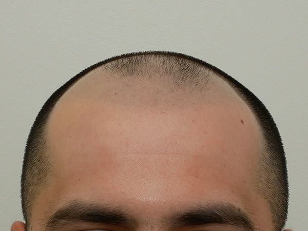 Hair Restoration