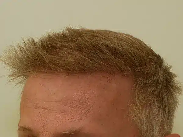 Hair Restoration
