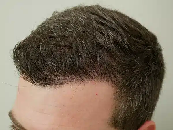 Hair Restoration