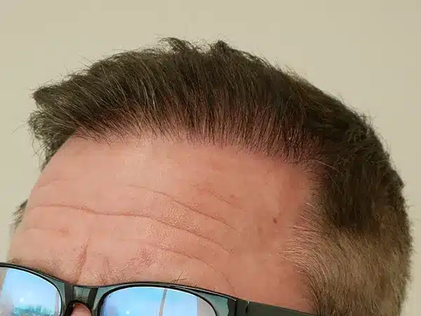 Hair Restoration