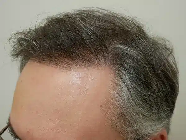 Hair Restoration