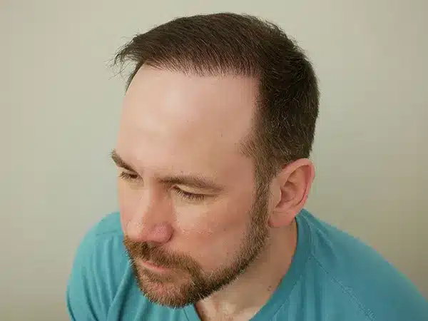 Hair Restoration
