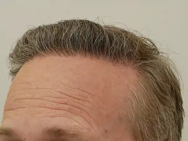 Hair Restoration