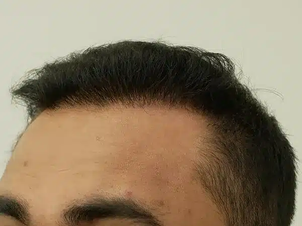 Hair Restoration