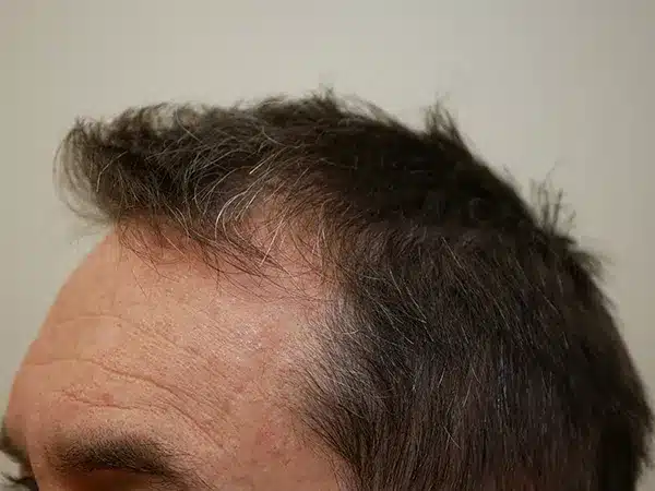 Hair Restoration