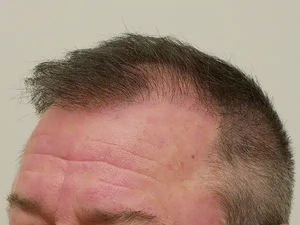 Hair Restoration