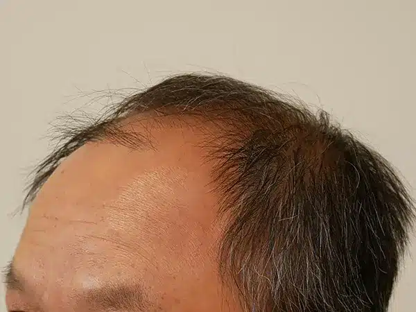 Hair Restoration