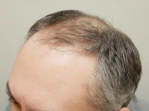 Hair Restoration