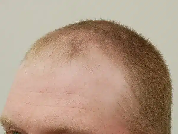 Hair Restoration