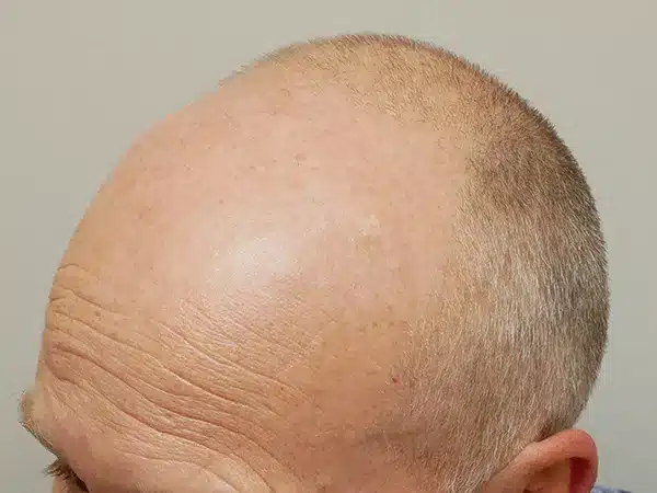 Hair Restoration