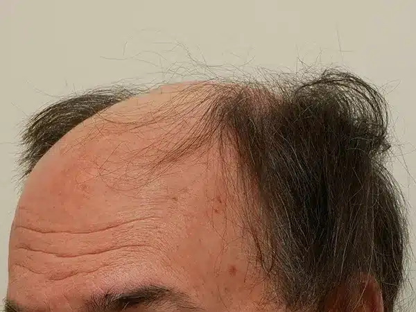 Hair Restoration
